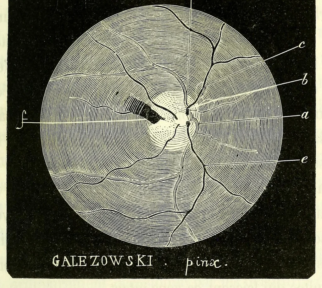 An illustration from Du diagnostic des maladies des yeux par la chromatoscopie rétinienne : précédé d'une étude sur les lois physiques et physiologiques des couleurs / par X. Galezowski, 1868, leaf 181