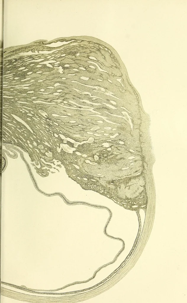An illustration from Das Sarkom des Auges [electronic resource], 1900, leaf 313