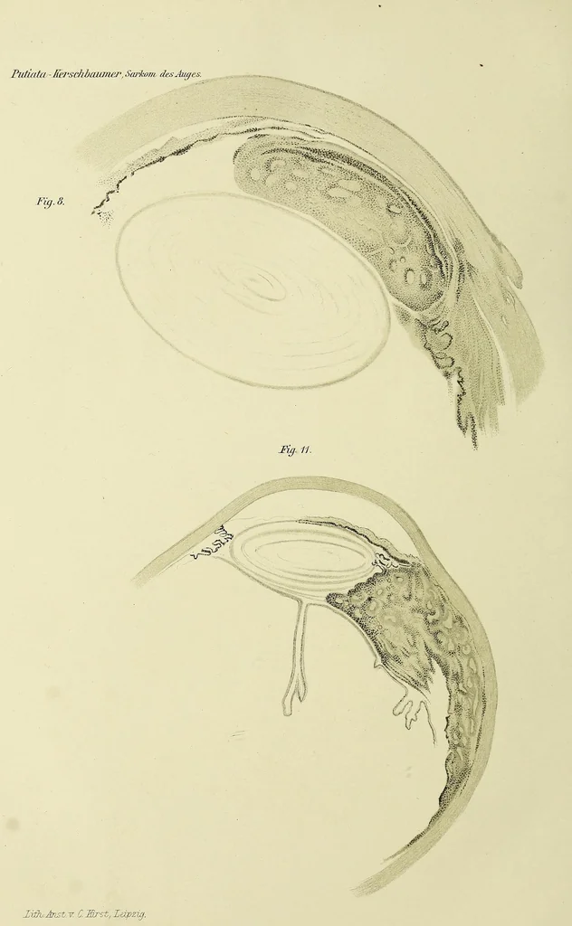 An illustration from Das Sarkom des Auges [electronic resource], 1900, leaf 324