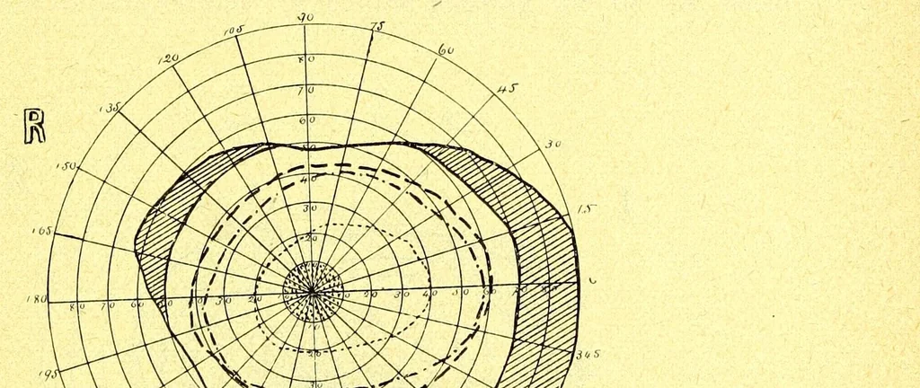 An illustration from Remarks on the field of vision in certain cases of "neglected eyes" / by G. E. de Schweinitz., 1895, leaf 11
