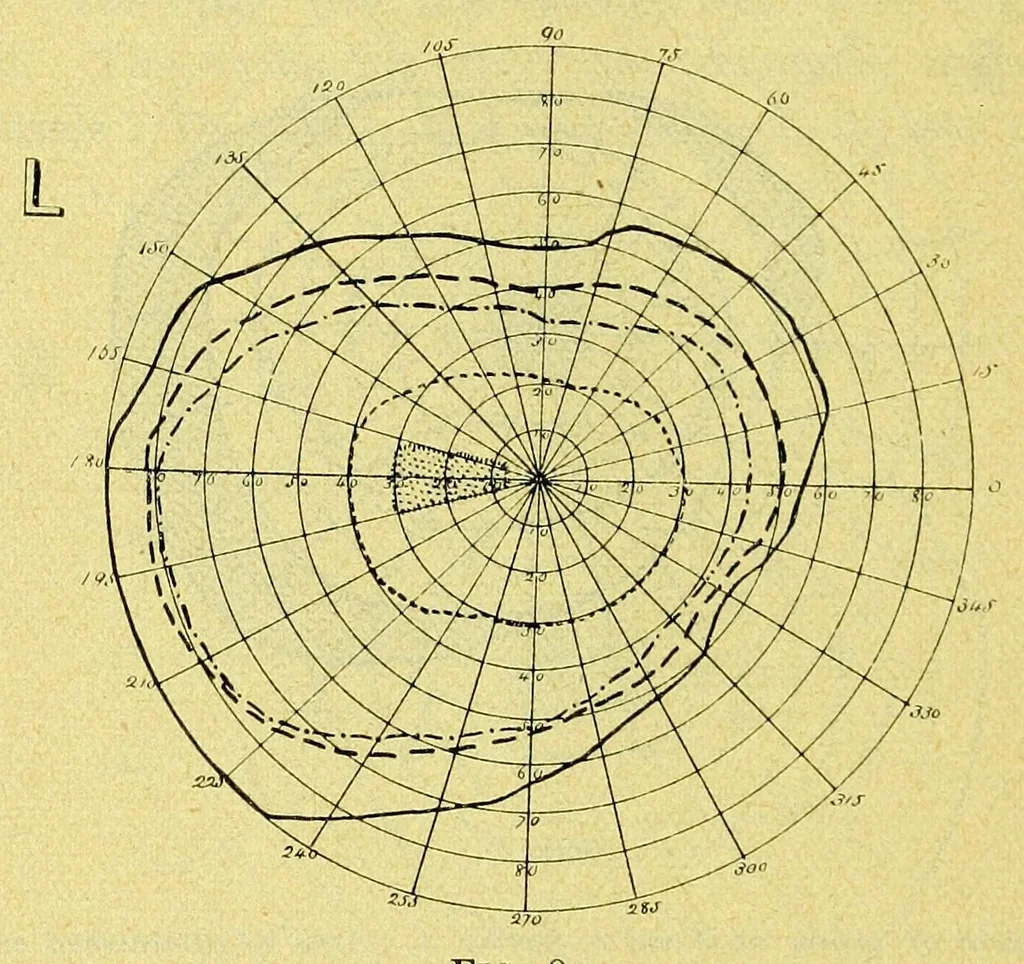 An illustration from Remarks on the field of vision in certain cases of "neglected eyes" / by G. E. de Schweinitz., 1895, leaf 12