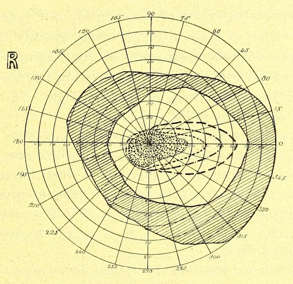 An illustration from Remarks on the field of vision in certain cases of "neglected eyes" / by G. E. de Schweinitz., 1895, leaf 13