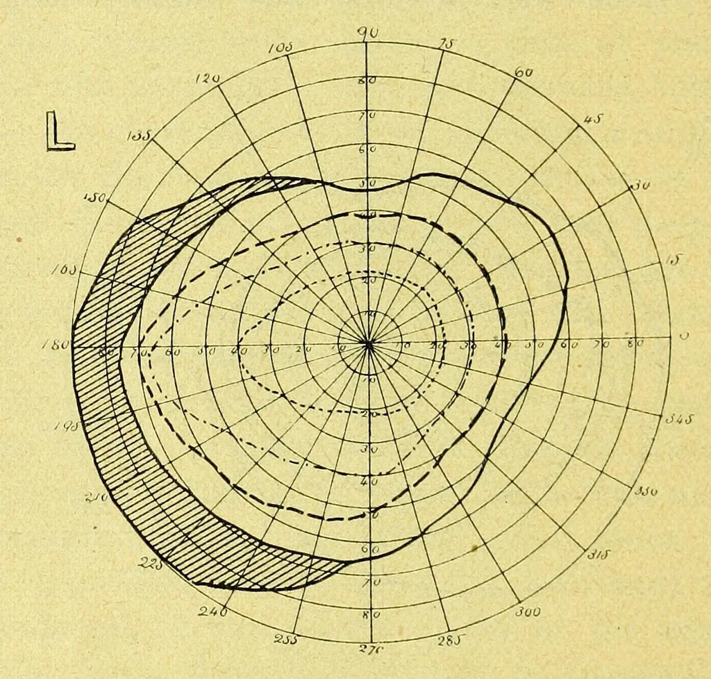 An illustration from Remarks on the field of vision in certain cases of "neglected eyes" / by G. E. de Schweinitz., 1895, leaf 6