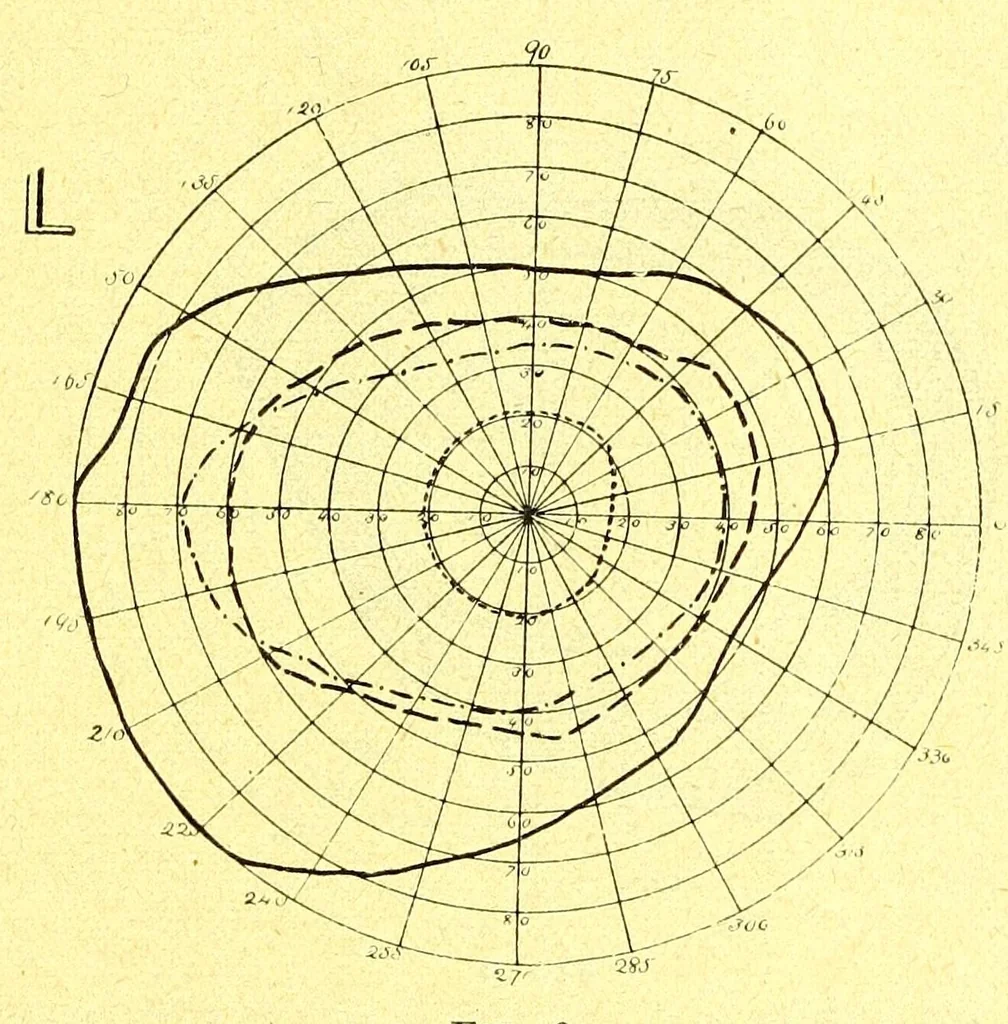 An illustration from Remarks on the field of vision in certain cases of "neglected eyes" / by G. E. de Schweinitz., 1895, leaf 7