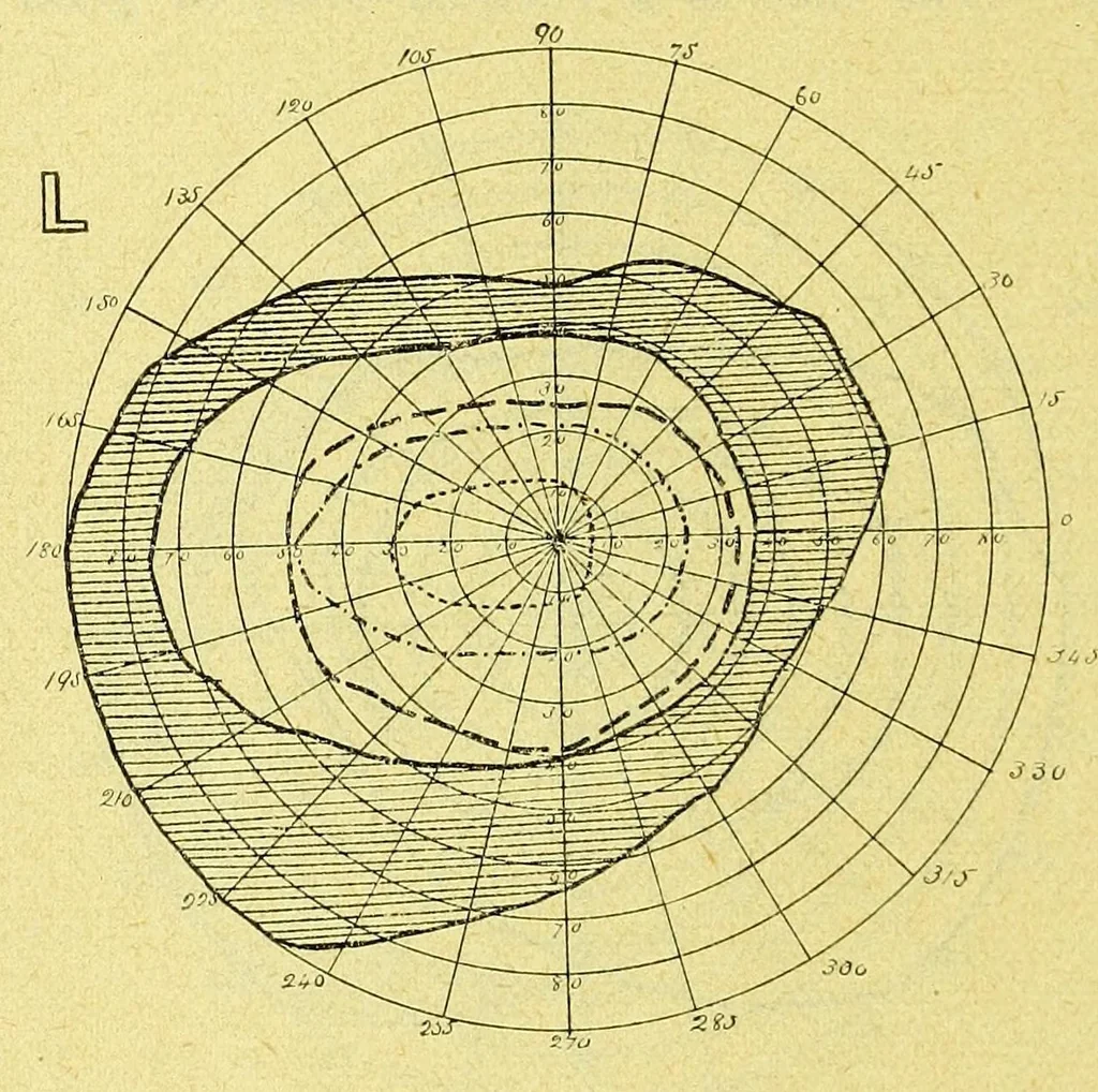 An illustration from Remarks on the field of vision in certain cases of "neglected eyes" / by G. E. de Schweinitz., 1895, leaf 8
