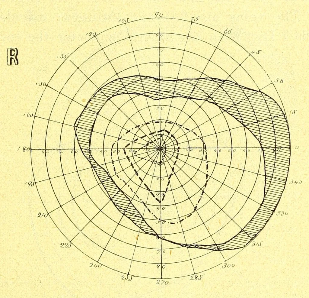 An illustration from Remarks on the field of vision in certain cases of "neglected eyes" / by G. E. de Schweinitz., 1895, leaf 9