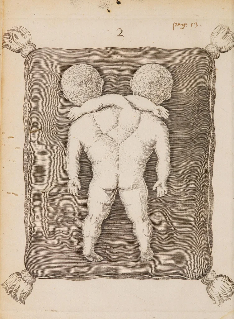 An illustration from Generosissimi, nobilissimi, expertissimique Di. Di. Ludovici de Bils à Copensdamme, Bonem, &c. Di. Urbis atque territorii Arbenburgici praetoris Specimina anatomica : cum clariss. doctissimorumque virorum epistolis aliquot & testimoniis., 1661, leaf 18