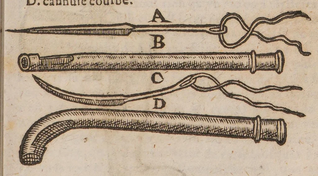 An illustration from La grande chirurgie de M. Guy de Chauliac, medecin tres fameux de l'Universite de Montpelier, composée l'an de grace mil trois cens soixante & trois, 1649, leaf 395