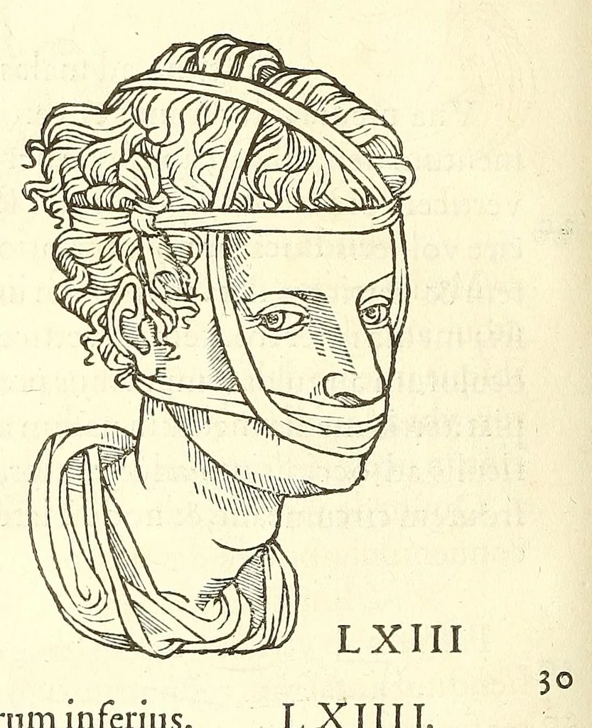 An illustration from Chirurgia, 1544, leaf 482