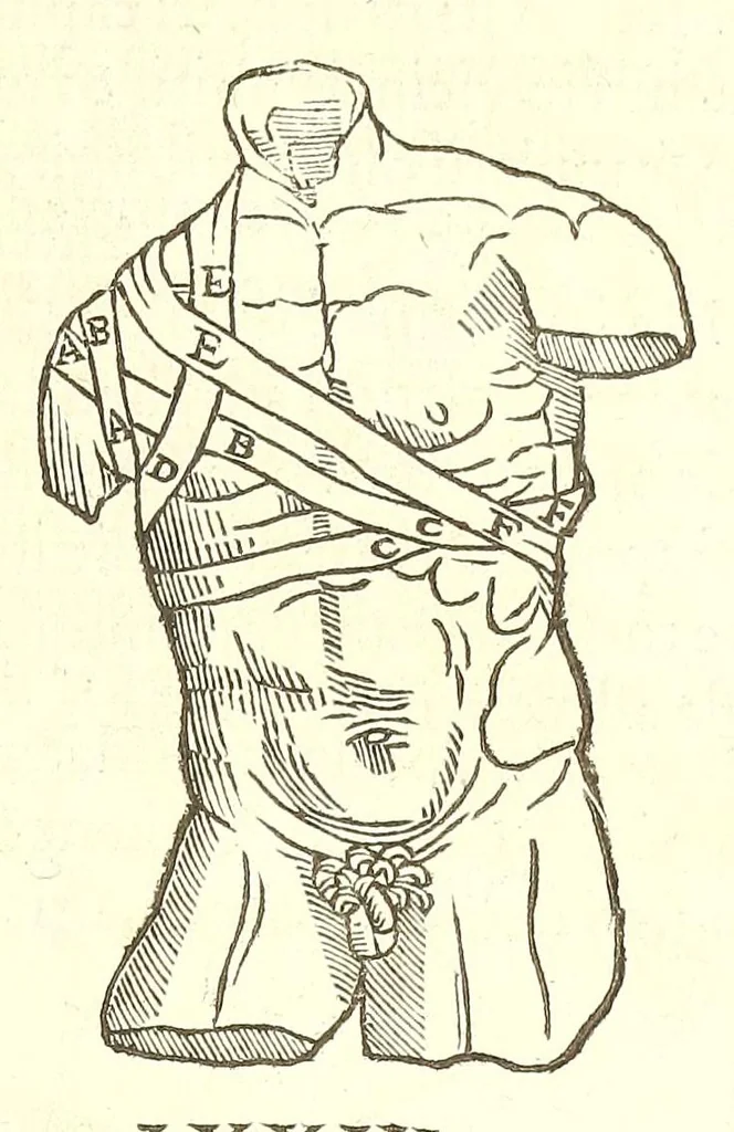 An illustration from Chirurgia, 1544, leaf 485
