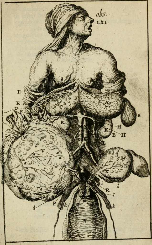 An illustration from Collectanea medico-physica, oft, Hollands jaar-register der genees- en natuur-kundige aanmerkingen van gantsch Europa &c. : beginnende met het jaar MDCLXXX : door eigen ondervinding en gemeen-making van verscheide heeren en liefhebbers, 1680, leaf 70