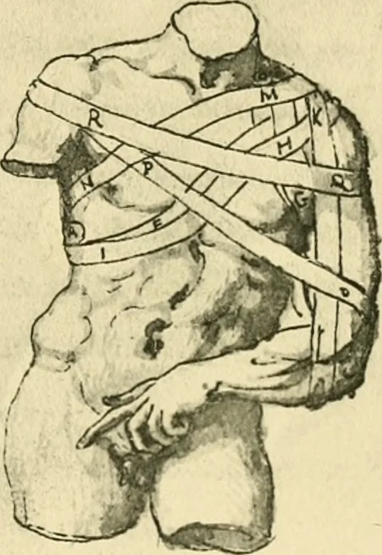 An illustration from Collection de chirurgiens grecs avec dessins attribués au Primatice. Reproduction réduite des 200 dessins du Manuscrit latin 6866 de la Bibliothèque nationale, 1908, leaf 114