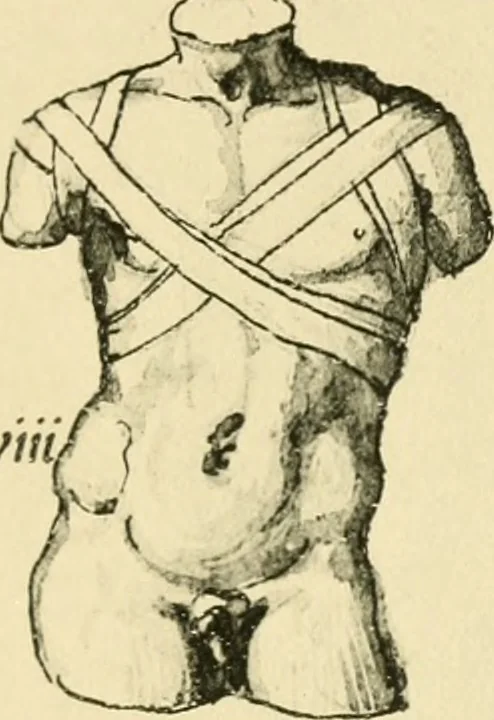 An illustration from Collection de chirurgiens grecs avec dessins attribués au Primatice. Reproduction réduite des 200 dessins du Manuscrit latin 6866 de la Bibliothèque nationale, 1908, leaf 116