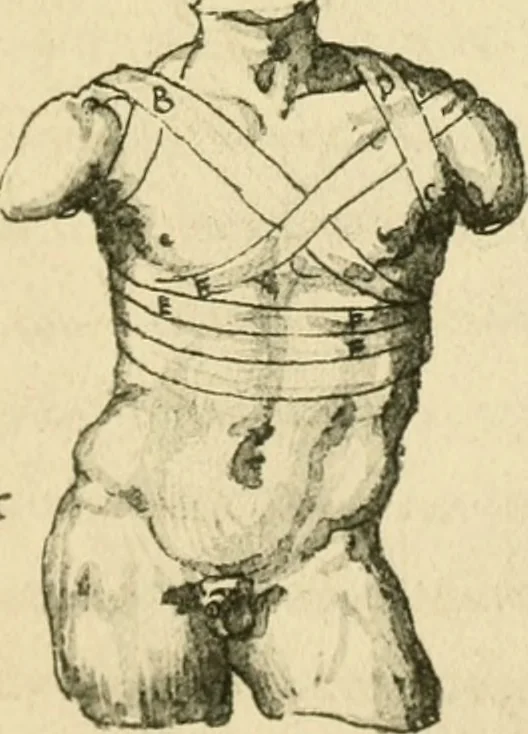 An illustration from Collection de chirurgiens grecs avec dessins attribués au Primatice. Reproduction réduite des 200 dessins du Manuscrit latin 6866 de la Bibliothèque nationale, 1908, leaf 116