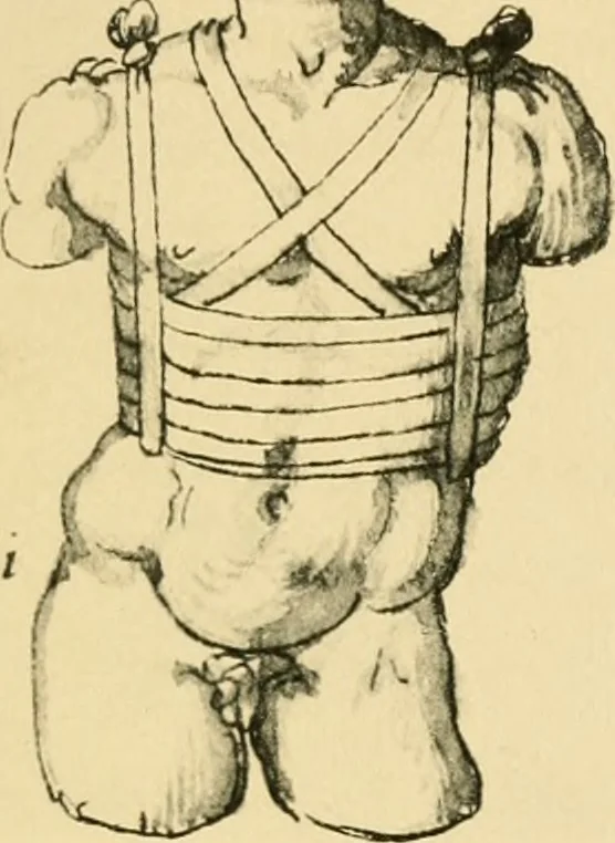 An illustration from Collection de chirurgiens grecs avec dessins attribués au Primatice. Reproduction réduite des 200 dessins du Manuscrit latin 6866 de la Bibliothèque nationale, 1908, leaf 118