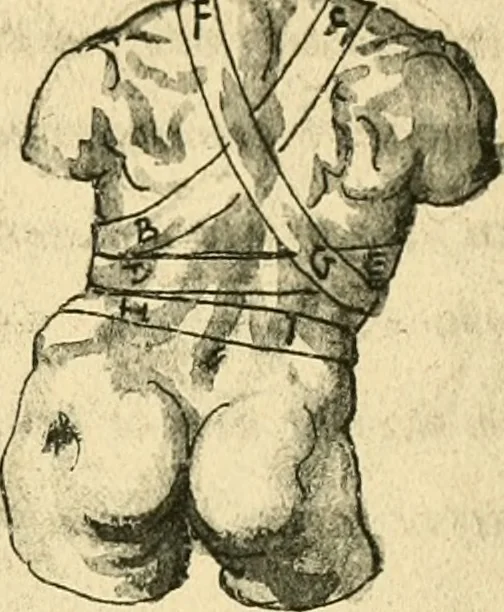 An illustration from Collection de chirurgiens grecs avec dessins attribués au Primatice. Reproduction réduite des 200 dessins du Manuscrit latin 6866 de la Bibliothèque nationale, 1908, leaf 122