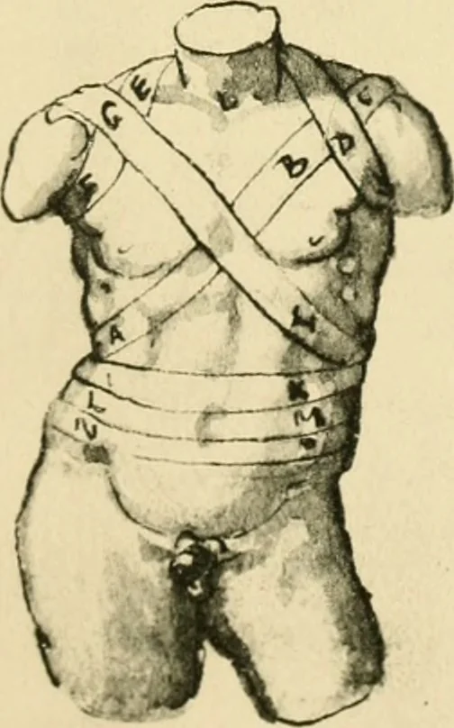 An illustration from Collection de chirurgiens grecs avec dessins attribués au Primatice. Reproduction réduite des 200 dessins du Manuscrit latin 6866 de la Bibliothèque nationale, 1908, leaf 124