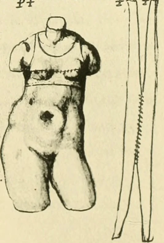 An illustration from Collection de chirurgiens grecs avec dessins attribués au Primatice. Reproduction réduite des 200 dessins du Manuscrit latin 6866 de la Bibliothèque nationale, 1908, leaf 126