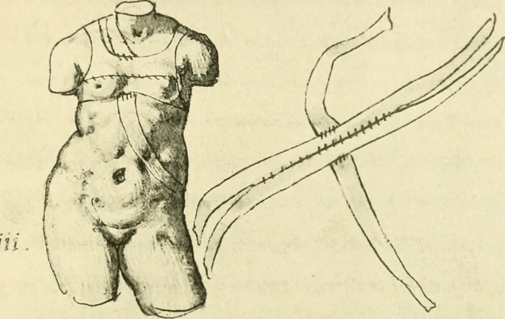 An illustration from Collection de chirurgiens grecs avec dessins attribués au Primatice. Reproduction réduite des 200 dessins du Manuscrit latin 6866 de la Bibliothèque nationale, 1908, leaf 128