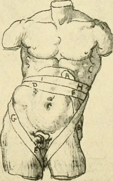 An illustration from Collection de chirurgiens grecs avec dessins attribués au Primatice. Reproduction réduite des 200 dessins du Manuscrit latin 6866 de la Bibliothèque nationale, 1908, leaf 128