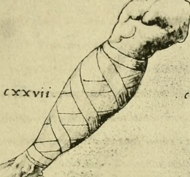 An illustration from Collection de chirurgiens grecs avec dessins attribués au Primatice. Reproduction réduite des 200 dessins du Manuscrit latin 6866 de la Bibliothèque nationale, 1908, leaf 142
