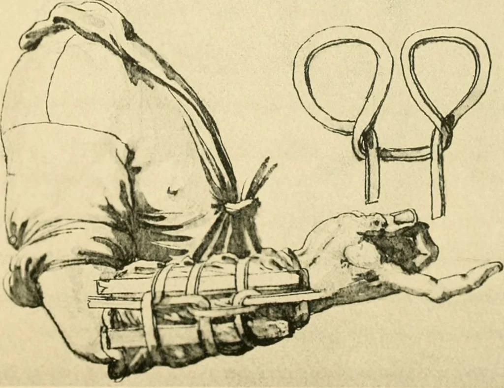 An illustration from Collection de chirurgiens grecs avec dessins attribués au Primatice. Reproduction réduite des 200 dessins du Manuscrit latin 6866 de la Bibliothèque nationale, 1908, leaf 148