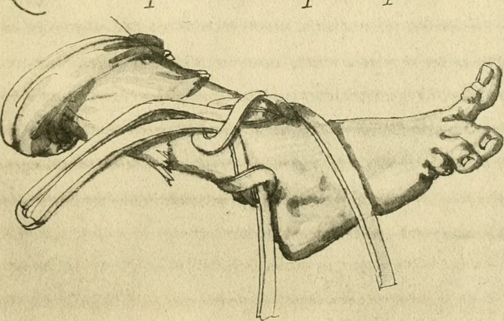 An illustration from Collection de chirurgiens grecs avec dessins attribués au Primatice. Reproduction réduite des 200 dessins du Manuscrit latin 6866 de la Bibliothèque nationale, 1908, leaf 152