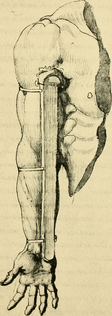 An illustration from Collection de chirurgiens grecs avec dessins attribués au Primatice. Reproduction réduite des 200 dessins du Manuscrit latin 6866 de la Bibliothèque nationale, 1908, leaf 50