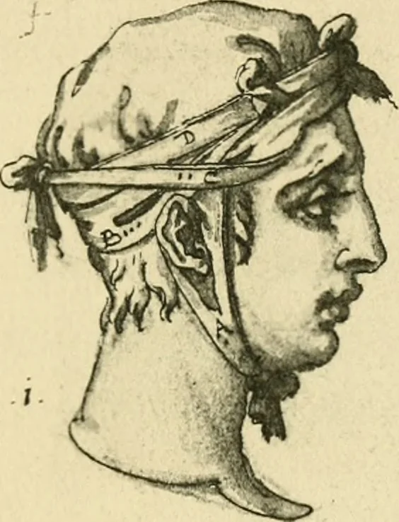 An illustration from Collection de chirurgiens grecs avec dessins attribués au Primatice. Reproduction réduite des 200 dessins du Manuscrit latin 6866 de la Bibliothèque nationale, 1908, leaf 72