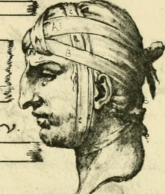 An illustration from Collection de chirurgiens grecs avec dessins attribués au Primatice. Reproduction réduite des 200 dessins du Manuscrit latin 6866 de la Bibliothèque nationale, 1908, leaf 76