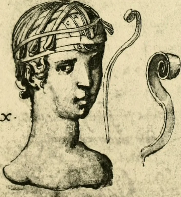 An illustration from Collection de chirurgiens grecs avec dessins attribués au Primatice. Reproduction réduite des 200 dessins du Manuscrit latin 6866 de la Bibliothèque nationale, 1908, leaf 78