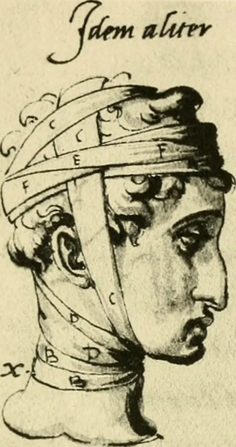 An illustration from Collection de chirurgiens grecs avec dessins attribués au Primatice. Reproduction réduite des 200 dessins du Manuscrit latin 6866 de la Bibliothèque nationale, 1908, leaf 84