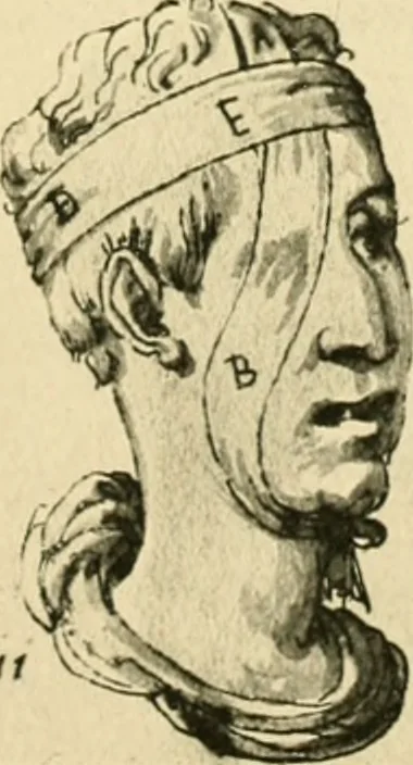 An illustration from Collection de chirurgiens grecs avec dessins attribués au Primatice. Reproduction réduite des 200 dessins du Manuscrit latin 6866 de la Bibliothèque nationale, 1908, leaf 92