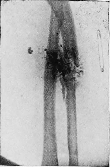 An illustration from X rays, 1918, leaf 203