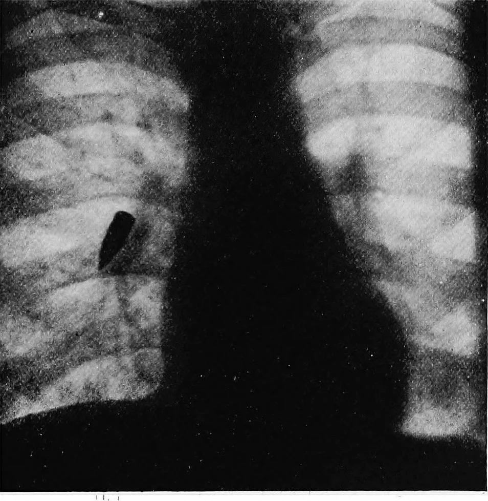 An illustration from X rays, 1918, leaf 204