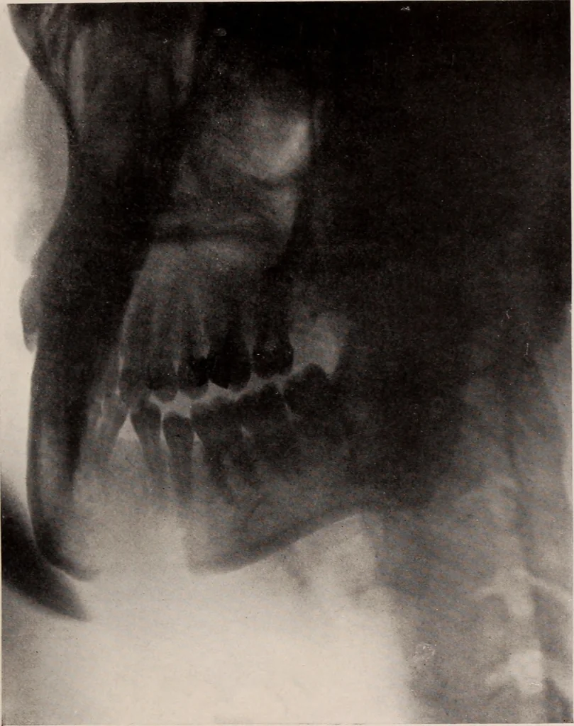 An illustration from Dental and oral radiography : a text book for students and practitioners of dentistry, 1916, leaf 104