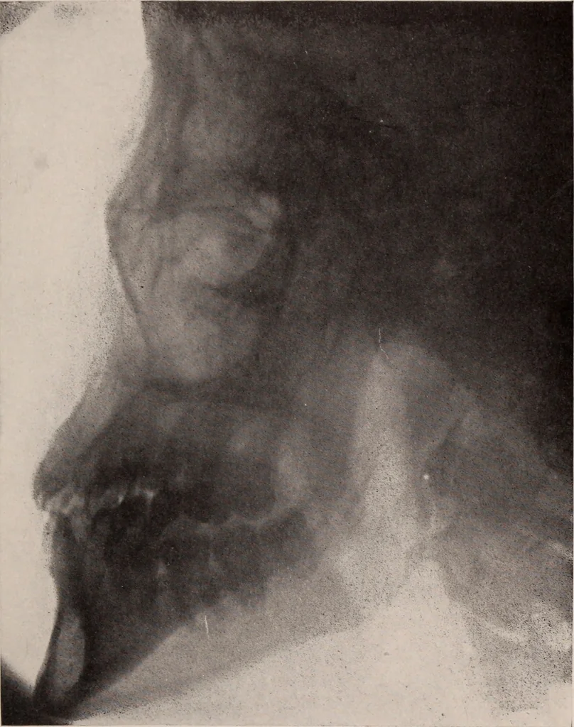 An illustration from Dental and oral radiography : a text book for students and practitioners of dentistry, 1916, leaf 106