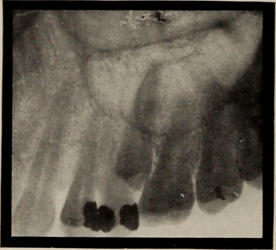 An illustration from Dental and oral radiography : a text book for students and practitioners of dentistry, 1916, leaf 135