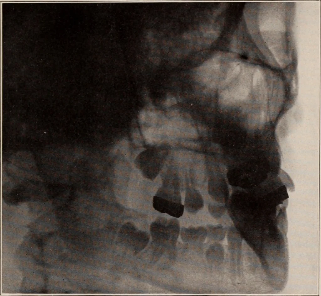 An illustration from Dental and oral radiography : a text book for students and practitioners of dentistry, 1916, leaf 136