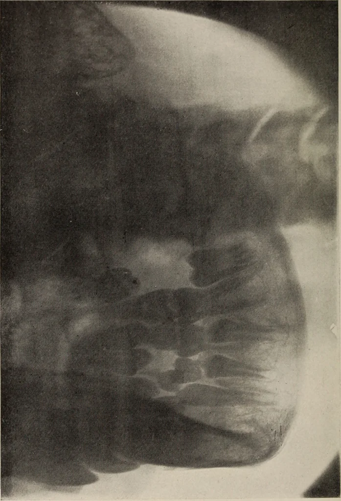 An illustration from Dental and oral radiography : a text book for students and practitioners of dentistry, 1916, leaf 137