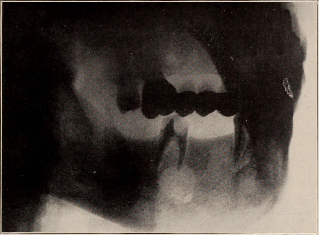 An illustration from Dental and oral radiography : a text book for students and practitioners of dentistry, 1916, leaf 138