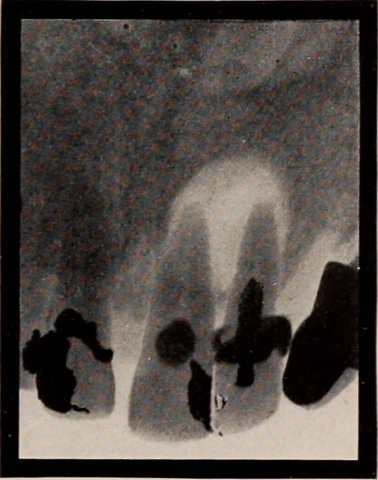 An illustration from Dental and oral radiography : a text book for students and practitioners of dentistry, 1916, leaf 138