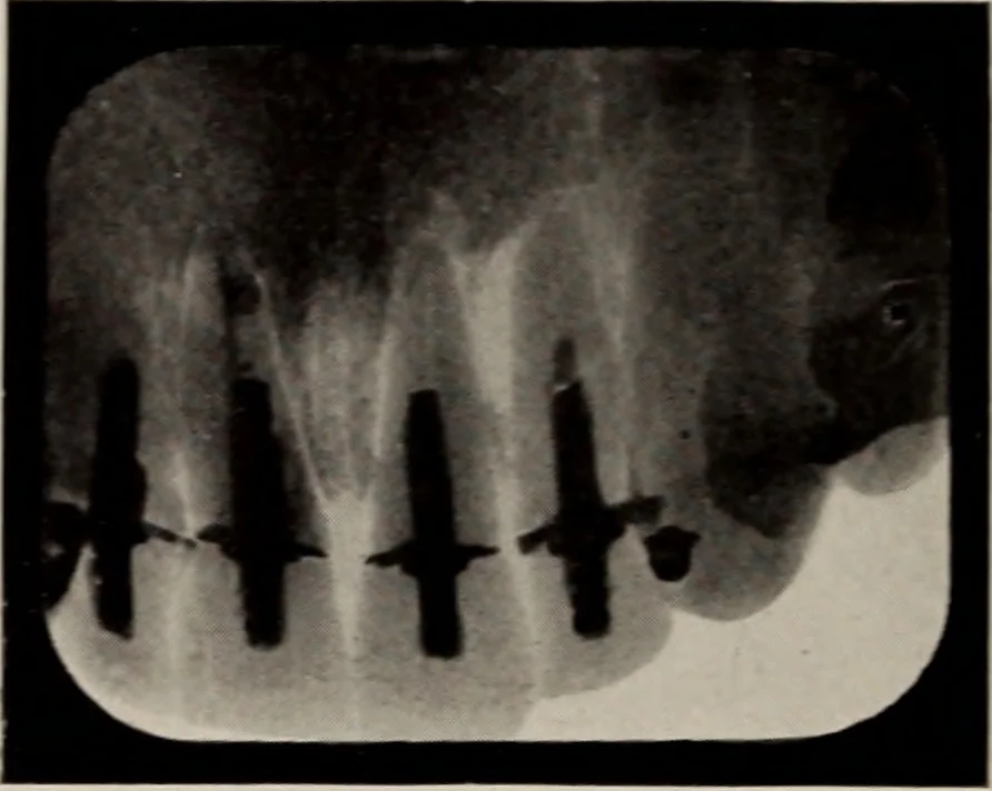 An illustration from Dental and oral radiography : a text book for students and practitioners of dentistry, 1916, leaf 139