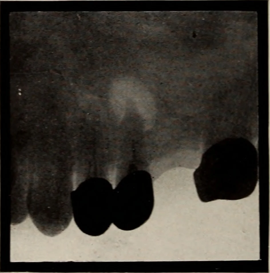 An illustration from Dental and oral radiography : a text book for students and practitioners of dentistry, 1916, leaf 139