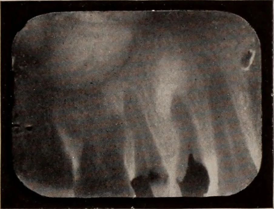 An illustration from Dental and oral radiography : a text book for students and practitioners of dentistry, 1916, leaf 140