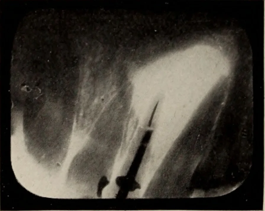 An illustration from Dental and oral radiography : a text book for students and practitioners of dentistry, 1916, leaf 141