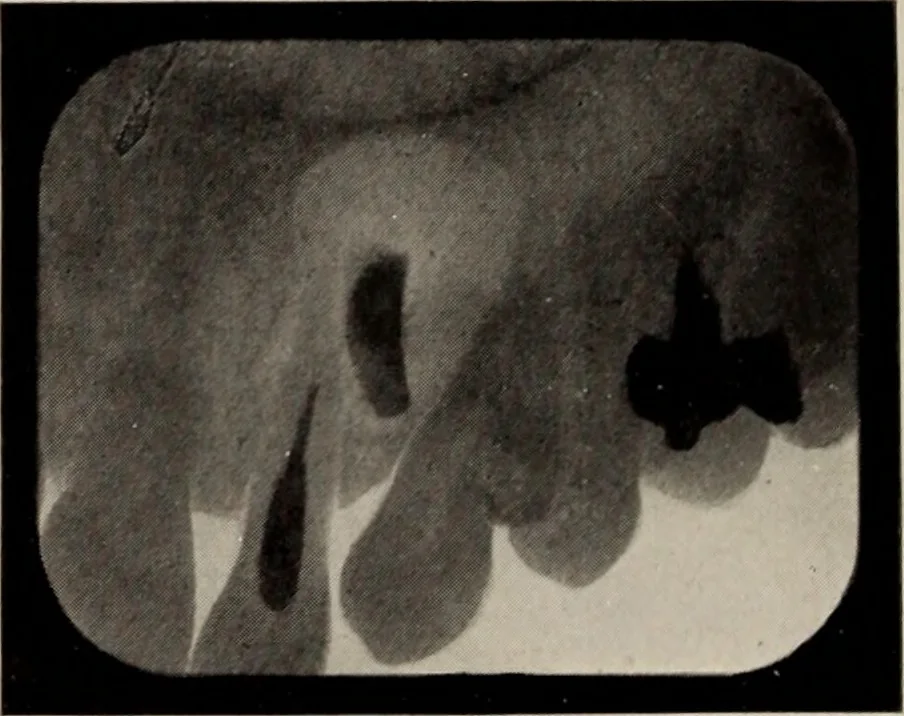 An illustration from Dental and oral radiography : a text book for students and practitioners of dentistry, 1916, leaf 141