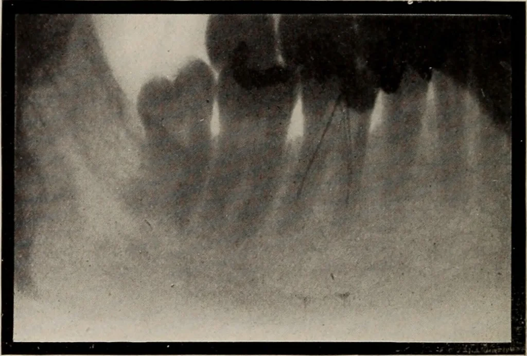 An illustration from Dental and oral radiography : a text book for students and practitioners of dentistry, 1916, leaf 145