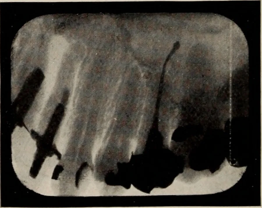 An illustration from Dental and oral radiography : a text book for students and practitioners of dentistry, 1916, leaf 145