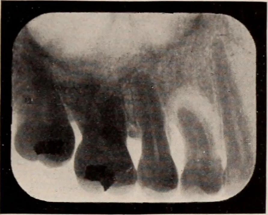 An illustration from Dental and oral radiography : a text book for students and practitioners of dentistry, 1916, leaf 146